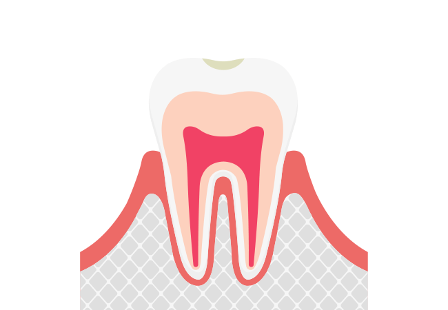 C0：ごく初期のむし歯（要観察）