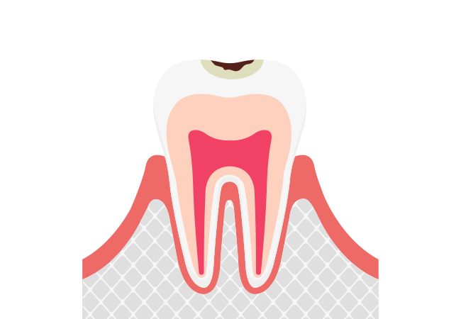 C1：エナメル質のむし歯