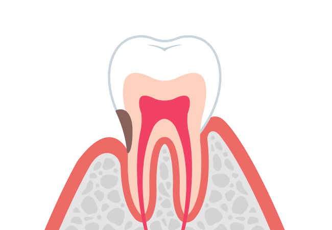 根C：根面う蝕（大人のむし歯）