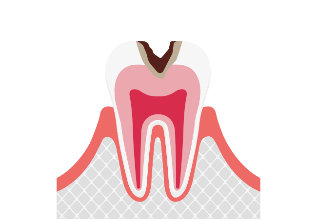 C2：象牙質まで進行したむし歯