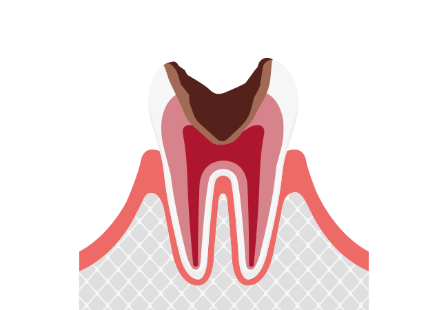 C3：神経まで進行したむし歯