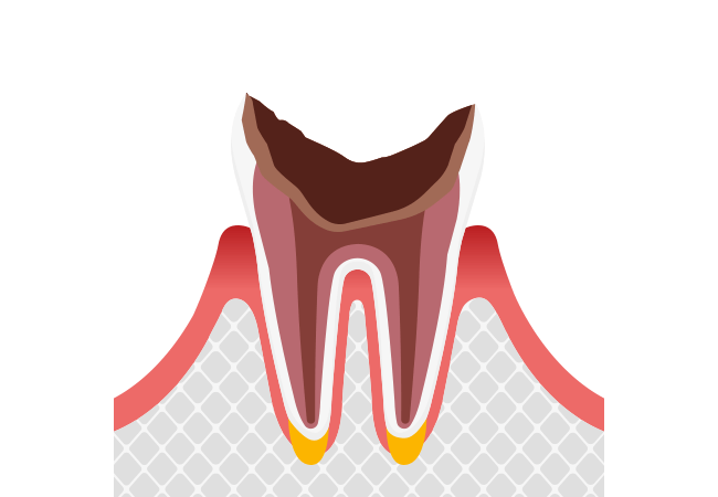 C4：歯根まで進行した末期のむし歯