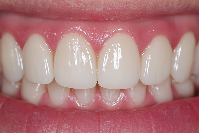 噛み合わせ治療について