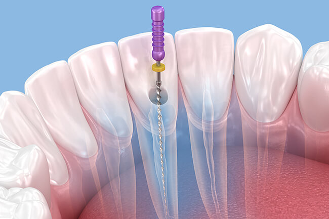 歯内治療・根管治療とは