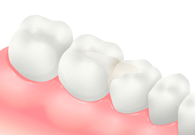 オールセラミックインレー
