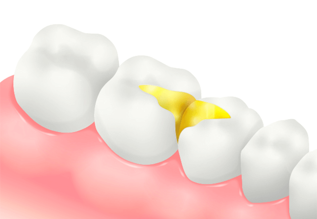 ゴールドインレー