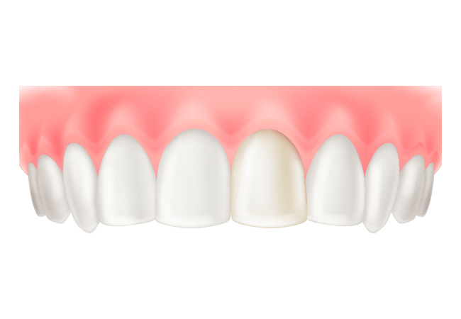 硬質レジン前装冠（前歯のみ）