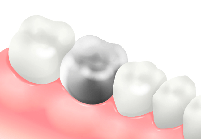 メタルクラウン（銀歯）