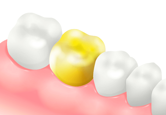 ゴールドクラウン