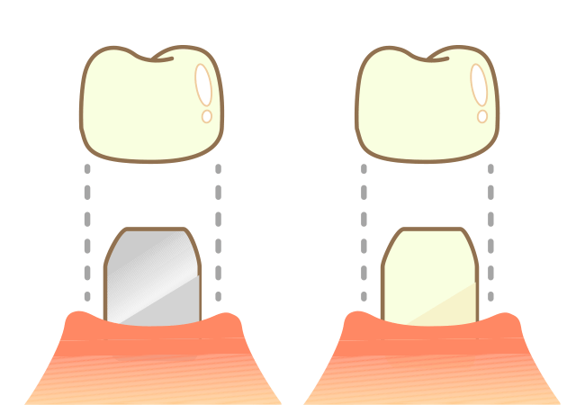コア（歯の土台）