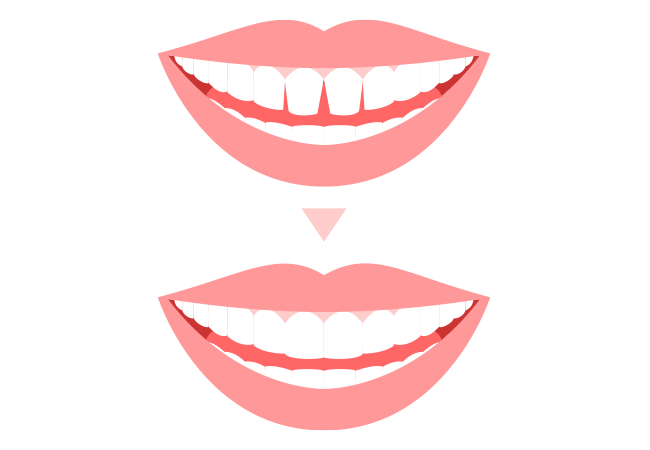 特殊な審美修復