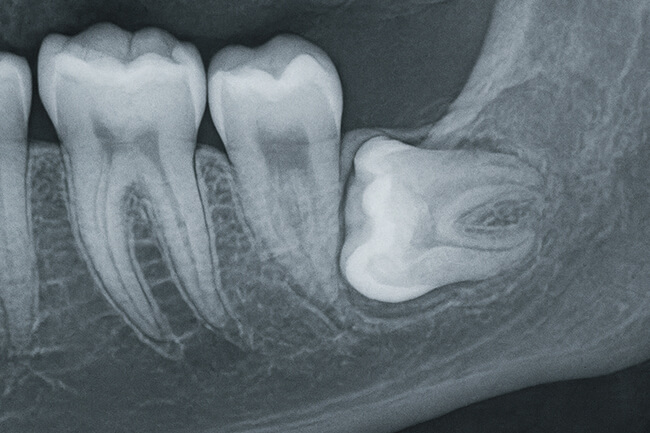 「親知らず」とは
